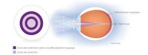 schema ActivControl miSight CooperVision